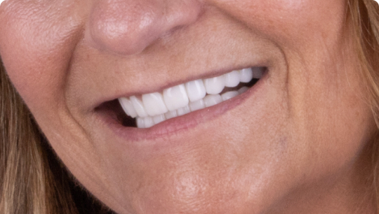 After laser whitening in Tijuana, Smile Together
