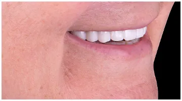 Smile of patient after all-on-4 treatment 