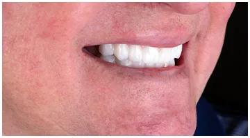 Smile of patient after all-on-4 treatment