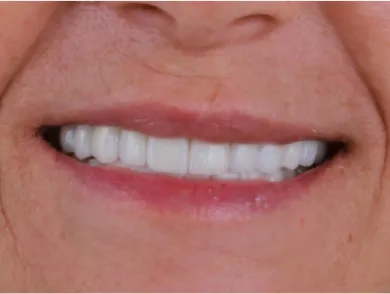 Patient smiling after dental crown procedure at Tijuana dentist.