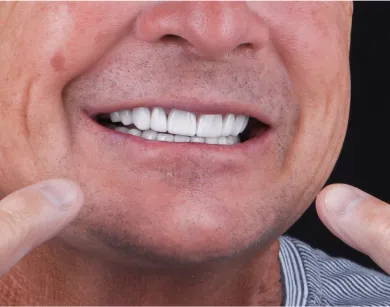 Patient smiling after root canal therapy in Tijuana