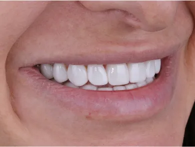 Patient showcasing a transformed smile after a smile makeover.