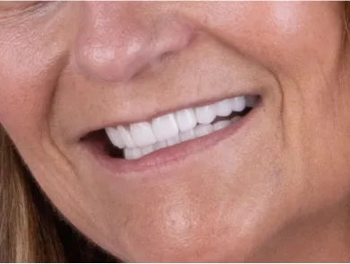 Patient's improved smile after receiving veneers at a Tijuana dentist.