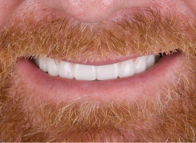 Patient showcasing a transformed smile after a smile makeover.