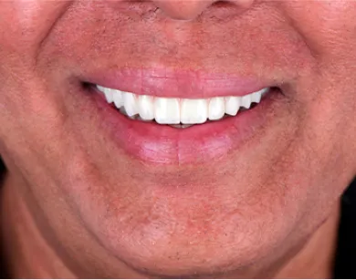 A patient smiling with newly restored teeth after All-on-4 dental implant treatment in Tijuana.