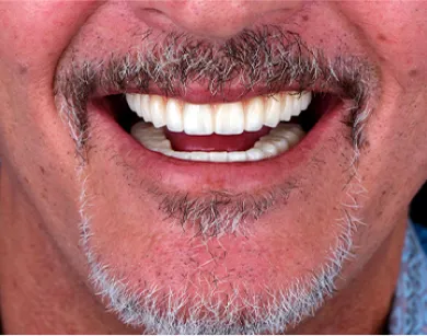 Close-up of a patient's new smile after All-on-4 dental implant procedure.