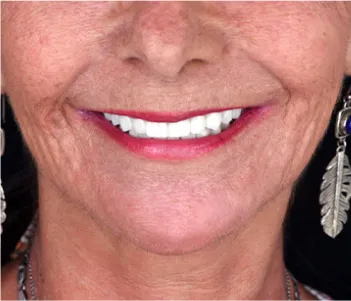 Profile view of a patient with restored facial aesthetics thanks to All-on-4 implants.