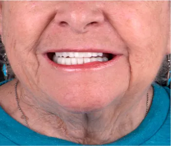 Patient enjoying a meal comfortably with restored teeth from All-on-4 implants.