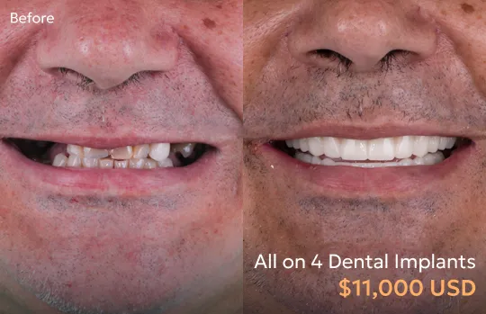 Dentist performing All-on-4 dental implant procedure in Tijuana