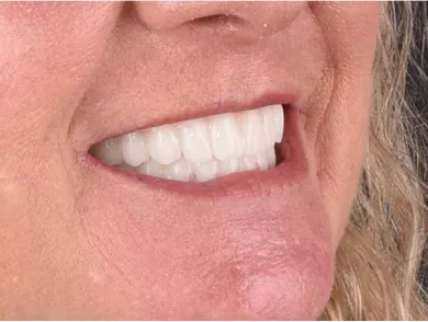 Before and after comparison of patient's smile at a Tijuana dental clinic.