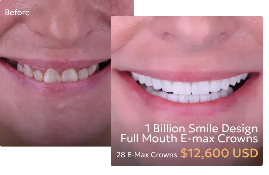 Before and after comparison of patients smile after "1 Billion Smile" crowns at a Tijuana dentist