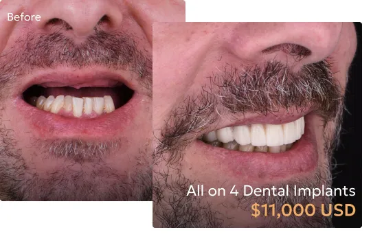 Before and after comparison of patient's smile after All-on-4 dental implants at a Tijuana dentist.