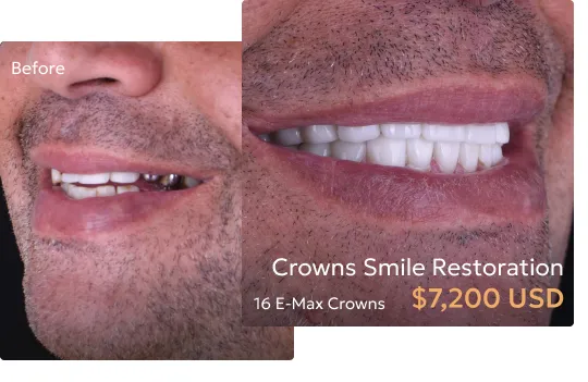 Before and after comparison of patient's smile after dental crown restoration at a Tijuana dentist.