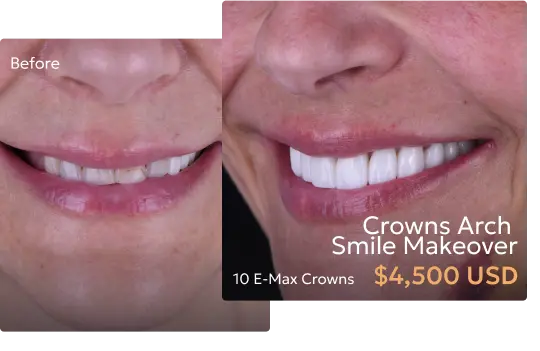 Before and after comparison of patient's smile with crowns used in a smile makeover at a Tijuana dentist.