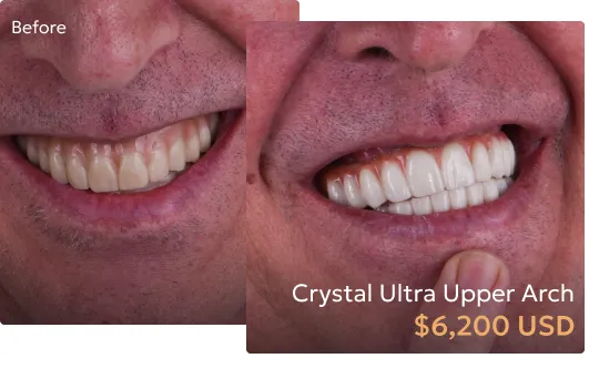  Before and after comparison of patient's smile after Crystal Ultra treatment at a Tijuana dentist.