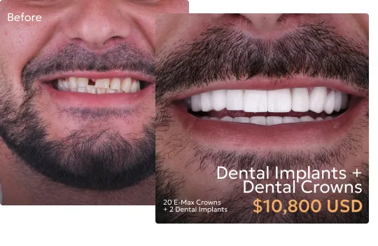 Before and after comparison of patient's smile after dental implants at a Tijuana dentist.