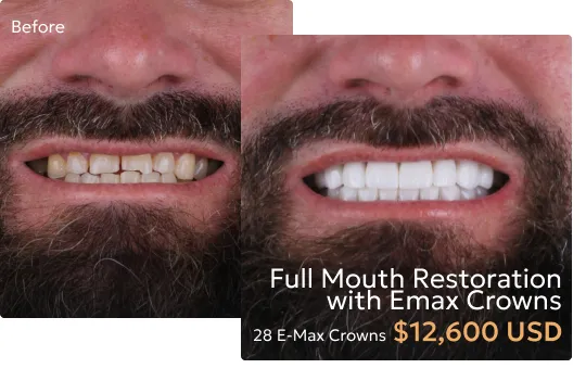 Before and after comparison of patient's smile after Emax crown restoration at a Tijuana dentist.