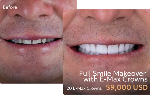  Before and after comparison of patient's smile after Emax crowns at a Tijuana dentist.