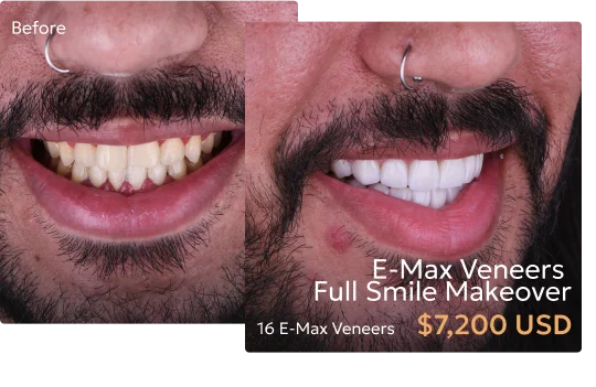 Before and after comparison of patient's smile with Emax veneers used in a smile makeover at a Tijuana dentist.