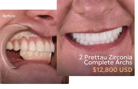 Before and after comparison of patient's smile after Prettau Zirconia arch at a Tijuana dentist