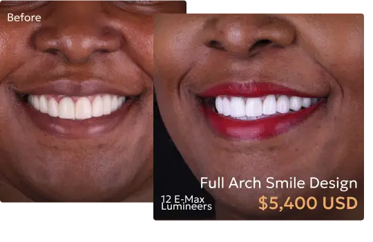 Before and after comparison of patient's smile after smile design treatment at a Tijuana dentist.