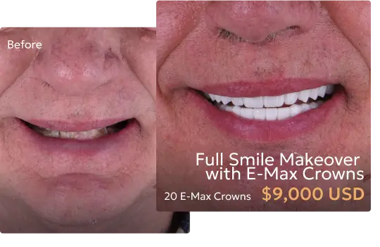 Before and after comparison of patient's smile with crowns used in a smile makeover at a Tijuana dentist.