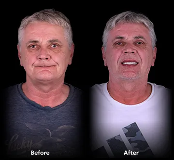 Before and after images of all-on-4 treatment in Tijuana 