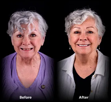 Before and after images of all-on-4 treatment in Tijuana