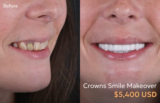 Before and after images of dental crowns in Tijuana