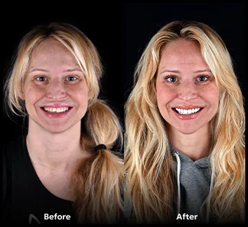 Before and after photo of patient smile transformation at Smile Together Tijuana dentist 