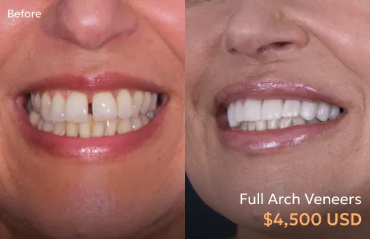 Before and after images of veneers by a Tijuana dentist