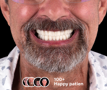 After-treatment results of 3-on-6 dental implants in Cancun
