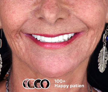 Patient's smile after all-on-4 treatment in Cancun