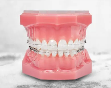 Close-up of ceramic braces placed over teeth, showcasing a discreet orthodontic option