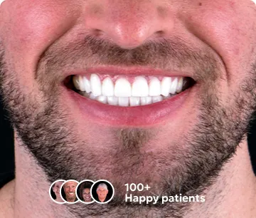 Patient's smile after dental crown treatment in Cancun