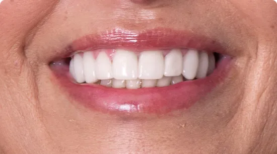 Full arch smile with dental crowns