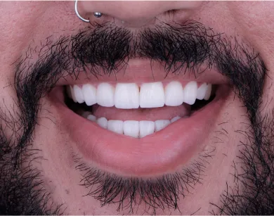 Before-and-after comparison of a patient's smile after receiving dental crowns in Tijuana.