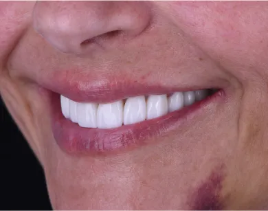 A detailed image showcasing the transformed smile of a patient post-dental crown treatment in Tijuana.