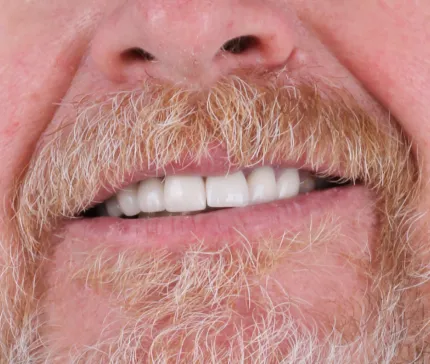 Close-up of a patient receiving dental crown treatment in Tijuana, highlighting precision dental care.