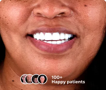 Patient's smile after dental lumineers treatment in Cancun