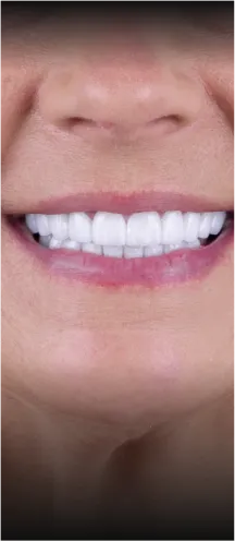 Patient with dental veneers in Tijuana