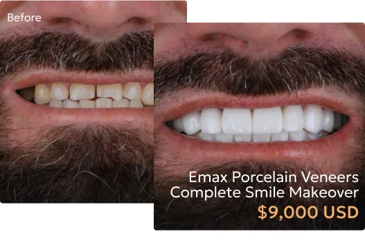 Detailed breakdown of dental veneers pricing in Tijuana, showing cost comparisons.