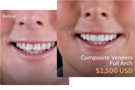 Information on the pricing for dental veneers in Tijuana, highlighting affordable options for patients.