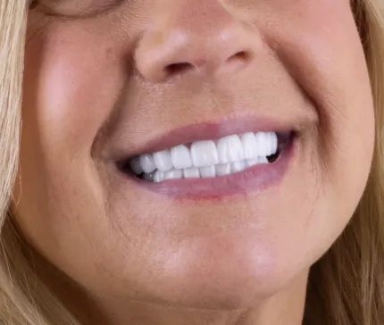 Close-up of a patient's teeth after getting veneers in Tijuana, showcasing a bright, restored smile.