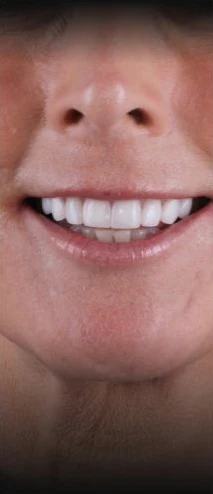 Patient after dental treatment by a Tijuana dentist