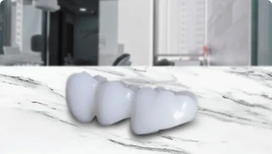 Real-life example of Emax porcelain crowns in Tijuana