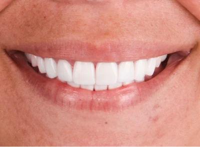 Patient smiling after dental crown procedure at Tijuana dentist.