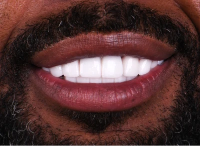 Patient showcasing a transformed smile after a smile makeover.