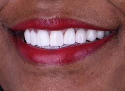 Patient showcasing a transformed smile after a smile makeover.