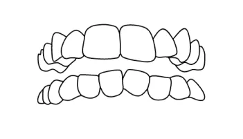 Patient with gapped teeth undergoing braces treatment in Tijuana to achieve a perfect smile.